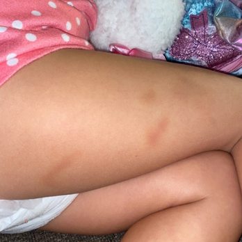 Grace Community School - The bruises they claimed were from falling - Child Care & Day Care Near Me - Fort Myers, Florida
