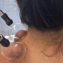 Dr. Lee's Newport Acupuncture - Cupping to circulate stagnant blood flow.