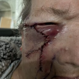 After photo of said operation that West Sound Dermatology wanted my mother to be awake for. After photo of said operation that West Sound Dermatology wanted my mother to be awake for.