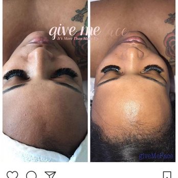 Healed By Tashi - Before and after. - Skin Care Near Me - Atlanta, Georgia Healed By Tashi - Before and after. - Skin Care Near Me - Atlanta, Georgia