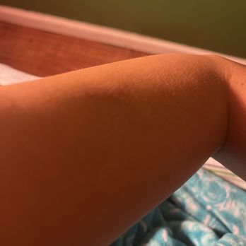 Susan's Seaside Spa - This is my healed arm after her work. - Massage Near Me - Seaside, California Susan's Seaside Spa - This is my healed arm after her work. - Massage Near Me - Seaside, California