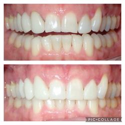 Adomian Garo, DDS - Before and after of front teeth bonding for a more esthetically pleasing look.