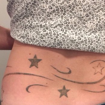 SpaDerma - After 1st treatment! - Medical Spas Near Me - Chicago, Illinois SpaDerma - After 1st treatment! - Medical Spas Near Me - Chicago, Illinois