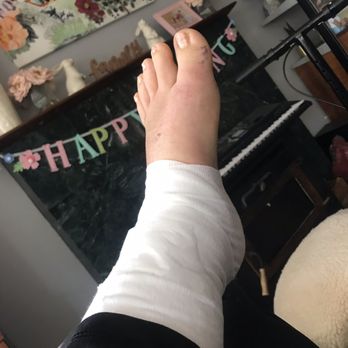 Robert Tonks, MD - Put this ace bandage on to feel secure 2 weeks post op, but didn't stay in for more than a few days. - Surgeons Near Me - San Diego, California Robert Tonks, MD - Put this ace bandage on to feel secure 2 weeks post op, but didn't stay in for more than a few days. - Surgeons Near Me - San Diego, California