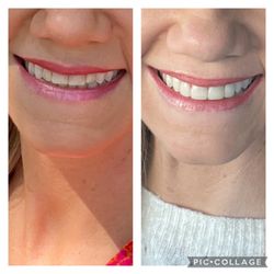 Cosmetic Dental Associates - Before and After...Note length and shape of front teeth