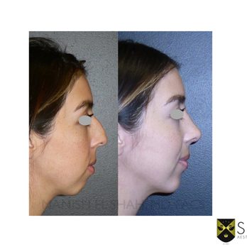 Shah Aesthetic Surgery - Rhinoplasty and Facelift Specialist - Ultrasonic Preservation Rhinoplasty Denver Dr. Shah - Plastic Surgeons Near Me - Englewood, Colorado