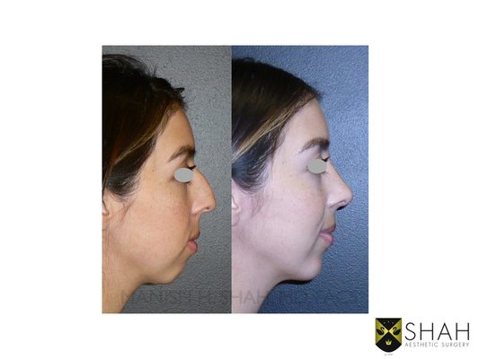 Shah Aesthetic Surgery - Rhinoplasty and Facelift Specialist by null