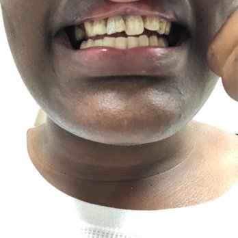Endospecialists - Front tooth was completely broken in half. Got a root canal done and it already cl looks completely better. I didn't feel a thing! - Endodontists Near Me - El Cerrito, California Endospecialists - Front tooth was completely broken in half. Got a root canal done and it already cl looks completely better. I didn't feel a thing! - Endodontists Near Me - El Cerrito, California
