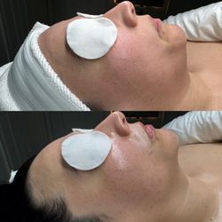 Bellatrix Beauty - Radiance Renewal Facial Before & After