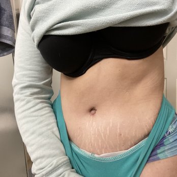 Hazani Plastic Surgery - Two weeks post op - Plastic Surgeons Near Me - Beverly Hills, California Hazani Plastic Surgery - Two weeks post op - Plastic Surgeons Near Me - Beverly Hills, California