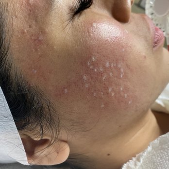 Nu Bloom Esthetics - TCA Cross for Scars - Skin Care Near Me - Diamond Bar, California Nu Bloom Esthetics - TCA Cross for Scars - Skin Care Near Me - Diamond Bar, California