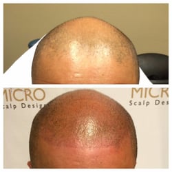 Micro Scalp Design