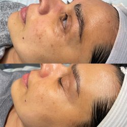 Dream Body & Beauty - Transformation with our Esthetician Alyzae after 2 treatments!