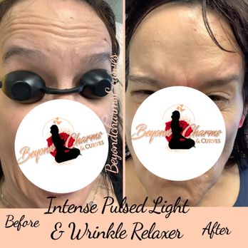 Beyond Charms & Curves - Neurotoxin results - Skin Care Near Me - Bakersfield, California Beyond Charms & Curves - Neurotoxin results - Skin Care Near Me - Bakersfield, California
