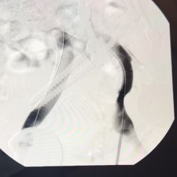 Emergency Department at NYU Langone Hospital - Brooklyn - Photo of deep venous thrombosis missed