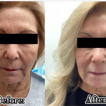 Rivertown Med Spa - FaceTite Procedure with Morpheus 8 ( Before and After ) - Medical Spas Near Me - Sleepy Hollow, New York Rivertown Med Spa - FaceTite Procedure with Morpheus 8 ( Before and After ) - Medical Spas Near Me - Sleepy Hollow, New York