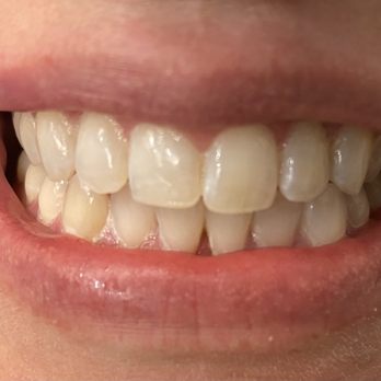 DaVinci Blanch teeth whiting  - Teeth Whitening Near Me - Highlands Ranch, Colorado