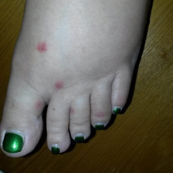 Holiday Motel - Bedbug bites on my left foot. It should be noted that I didn't know it at the time, but I actually saw a bedbug in the motel bathroom. - Hotels Near Me - Bend, Oregon