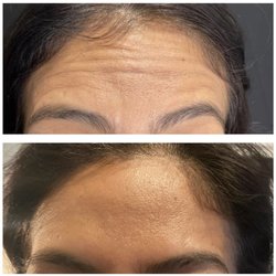 Beauty for ashes - Wrinkle removal