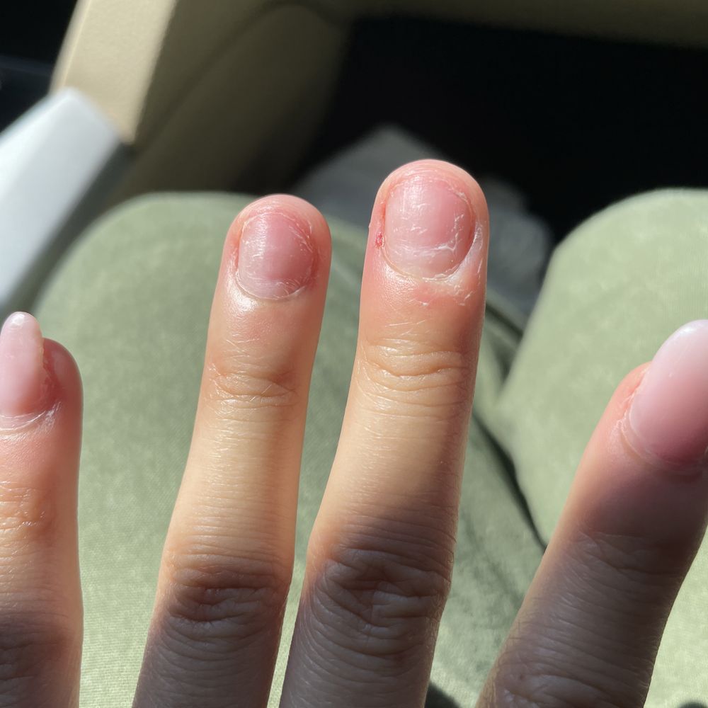Social Nail Lounge - Evidence of my nails being super thin. It really hurts and I don't think my nail tech did a good job w the application - Nail Salons Near Me - Tysons, Virginia Social Nail Lounge - Evidence of my nails being super thin. It really hurts and I don't think my nail tech did a good job w the application - Nail Salons Near Me - Tysons, Virginia