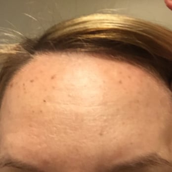 Forever Ageless - This my forehead BEFORE Lumeca IPL with Karyn. Now check out the after! - Medical Spas Near Me - Newport Beach, California