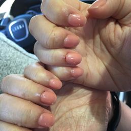 Clearly bleeding cuticles.