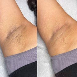 Coconut Grove Aesthetics - Before & After: Underarm Wax
