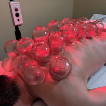 Light Health Center - Fire cupping therapy improves circulation, releases muscle tension, and helps reduce pain and stress. - Acupuncture Near Me - San Jose, California Light Health Center - Fire cupping therapy improves circulation, releases muscle tension, and helps reduce pain and stress. - Acupuncture Near Me - San Jose, California