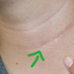 Hieu Ball , MD - CalSpine MD - Ni se nota mi cirujía, el doctor es un artista me dejo estéticamente perfecta mi sirujia, gracias doctor.