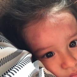 No reason given why she had bumps on her forehead