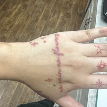 Heartbreaker Tattoo - More chemical burning and scars - Tattoo Near Me - Spokane, Washington Heartbreaker Tattoo - More chemical burning and scars - Tattoo Near Me - Spokane, Washington