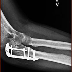 Hands On Hands Rehabilitation Center - Xray is metal and screws