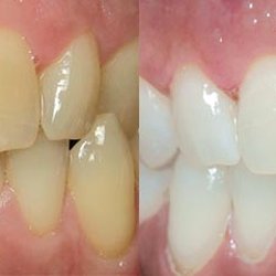 Dental Solutions of Avon - Teeth Whitening Before and After