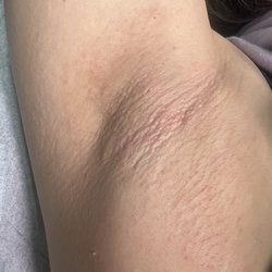 Bare It All Beauty Bar - Underarm after