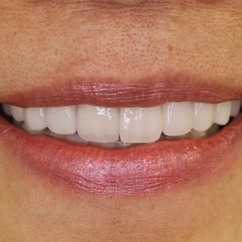 Simply Veneers - Porcelain Veneers layered for a natural smile - Cosmetic Dentists Near Me - Newport Beach, California Simply Veneers - Porcelain Veneers layered for a natural smile - Cosmetic Dentists Near Me - Newport Beach, California