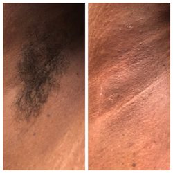 Lavish Luxe Beauty Bar - Before & after photos of an underarm waxing. I used @starpilwax pink polymer wax for a painless wax experience.