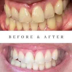 La Vie Airbrush Tanning - 30min express teeth whitening with zero to very little sensitivity. 2-8 shades lighter guaranteed