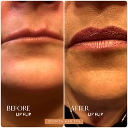 ZenVita Med Spa - Lip Flip