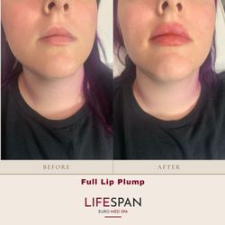 LifeSpan Euro MedSpa - Full Lip Plump!