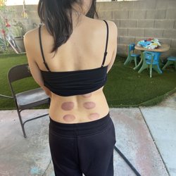 Athleticare Physical Therapy & Sports Performance - Cupping treatments for back pains