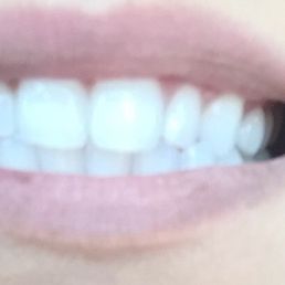 The hygienist cleaned my teeth and got rid of my coffe stains. My teeth feel so much cleaner and whiter. He's such a sweet guy! Thank you