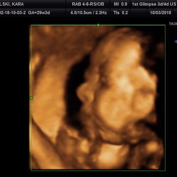 1st Glimpse 3d 4d Ultrasound - Ultrasound Imaging Centers Near Me - Valparaiso, Indiana