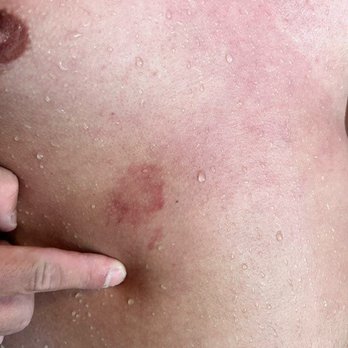 Grand Oasis Cancún - Fungus from pool (Doctor confirmed) - Hotels Near Me - Cancún, ROO