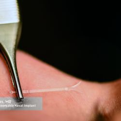 Nathan E Nachlas, MD - Nathan E. Nachlas, MD, currently the world's most experienced user of the Spirox Latera ™ implant to restore nasal breathing.