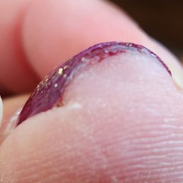Cut under my toe Cut under my toe
