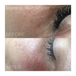 Skin & Body LA - After 1 RF TREATMENT