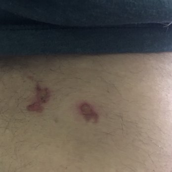 AB Acupuncture - A week later - Acupuncture Near Me - El Cajon, California