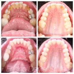 Encino Dental Smile - Deep cleaning known as scaling and root planing done to clean stains, plaque and calculus. Most important step for teeth whitening.