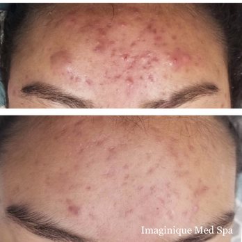 Imaginique Med Spa - Pre & Post Acne Therapy - Laser Hair Removal Near Me - Richardson, Texas Imaginique Med Spa - Pre & Post Acne Therapy - Laser Hair Removal Near Me - Richardson, Texas