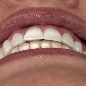 Smile Again Dental - misaligned - General Dentistry Near Me - Garland, Texas